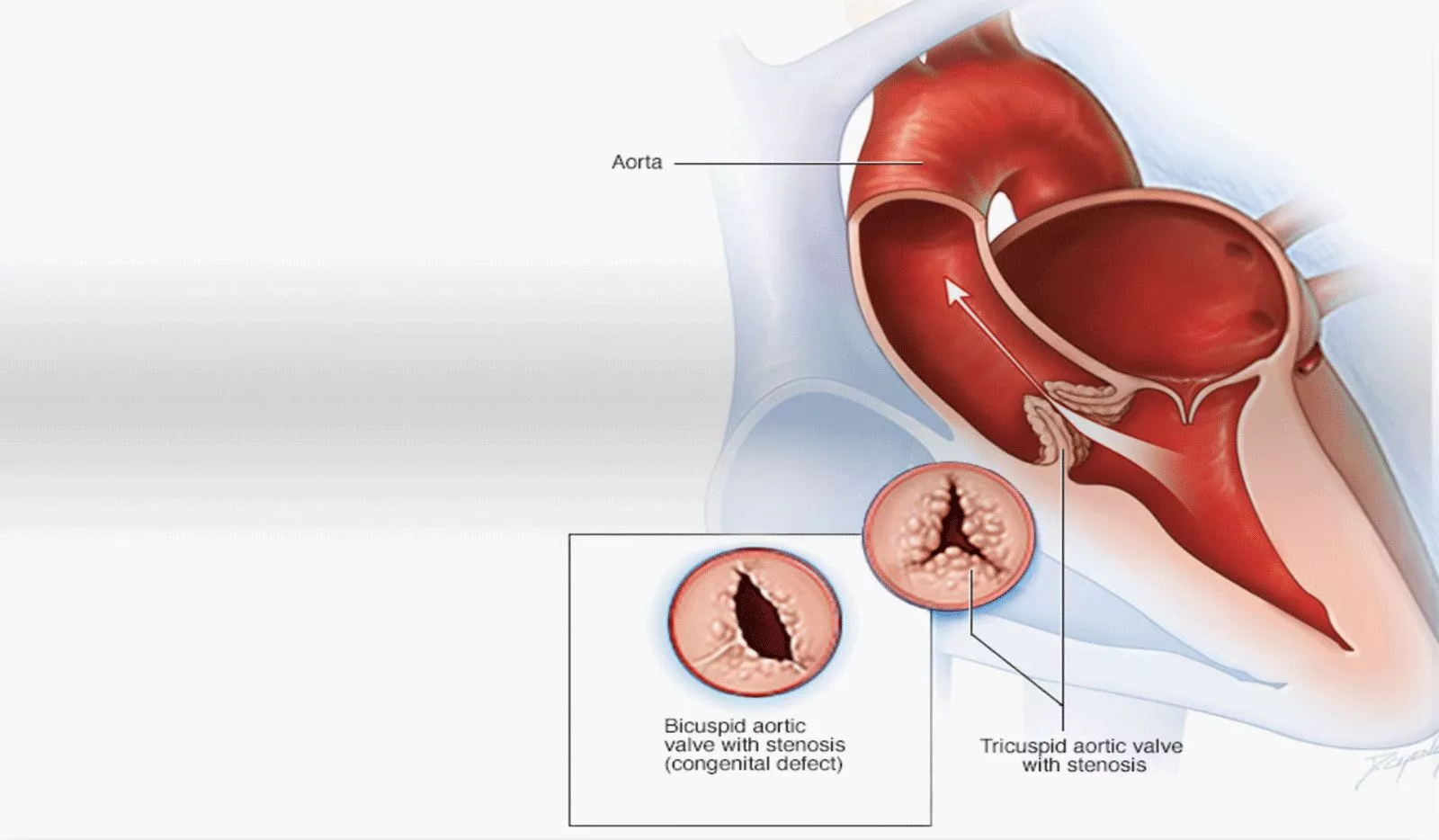 Sudden Cardiac Attacks - Causes and Symptoms